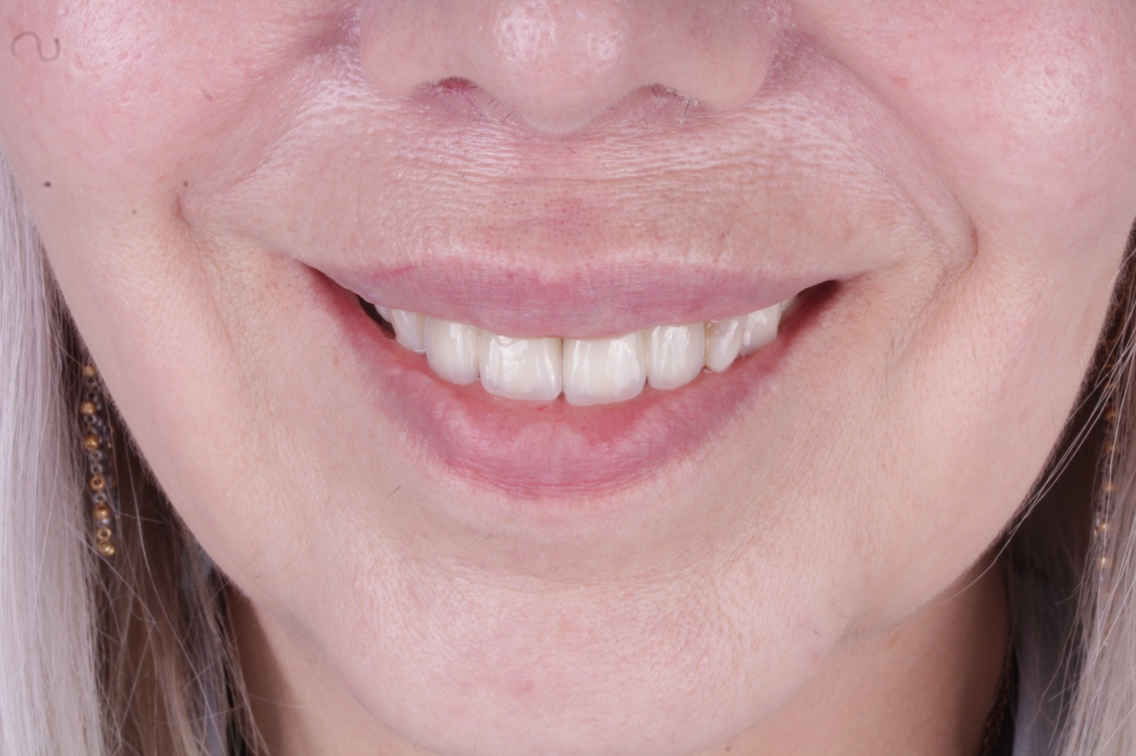 Vista complementaria del resultado del caso dental E. L.