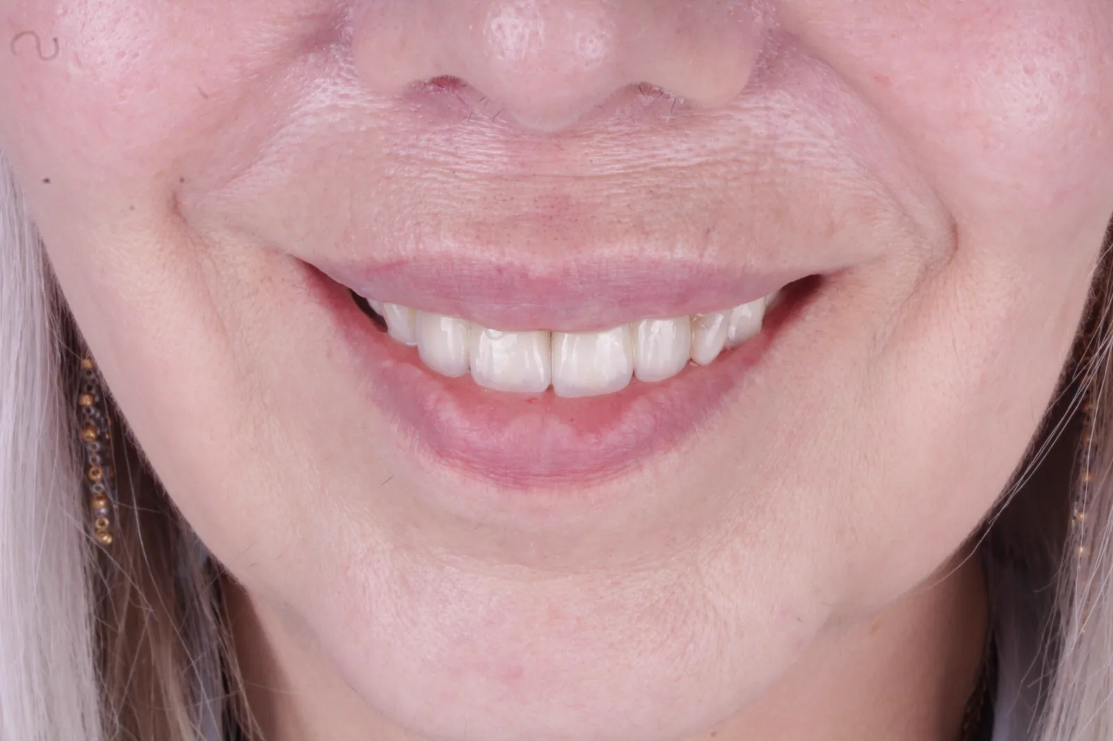 Vista complementaria del resultado del caso dental E. L.