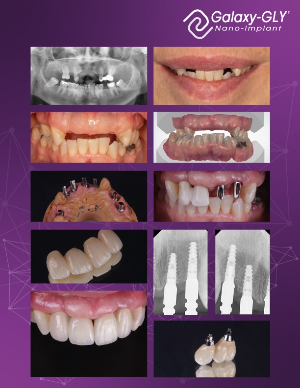 Resumen visual del caso E. L. con Galaxy GLY Nano-Implant