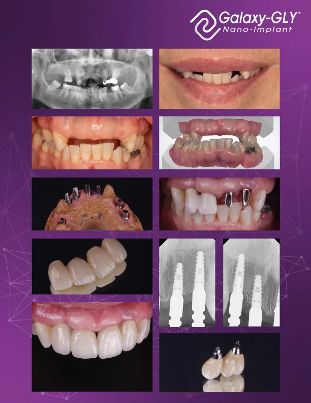 Resumen visual del caso E. L. con Galaxy GLY Nano-Implant